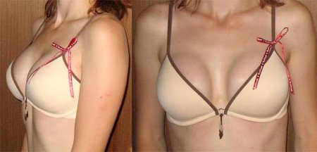 Увеличение груди. Личный дневник одной девушки (21 фото)