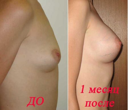 Увеличение груди. Личный дневник одной девушки (21 фото)