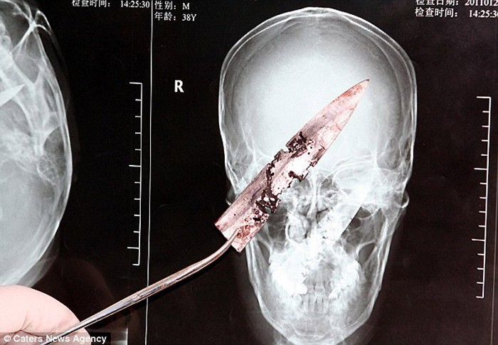 Китаец прожил четыре года с ножом в черепе (4 фото)